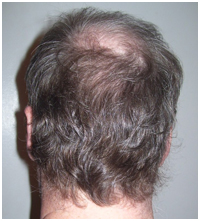 Male pattern baldness