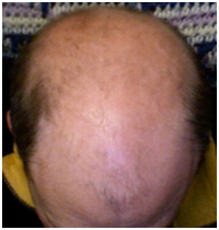 Male pattern baldness