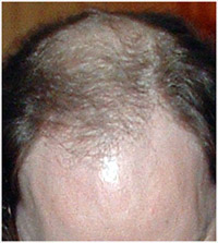 Male pattern baldness